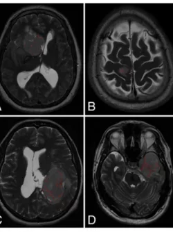 MVI Measured on axial T2-weighted MR images using the ITK-SNAP software