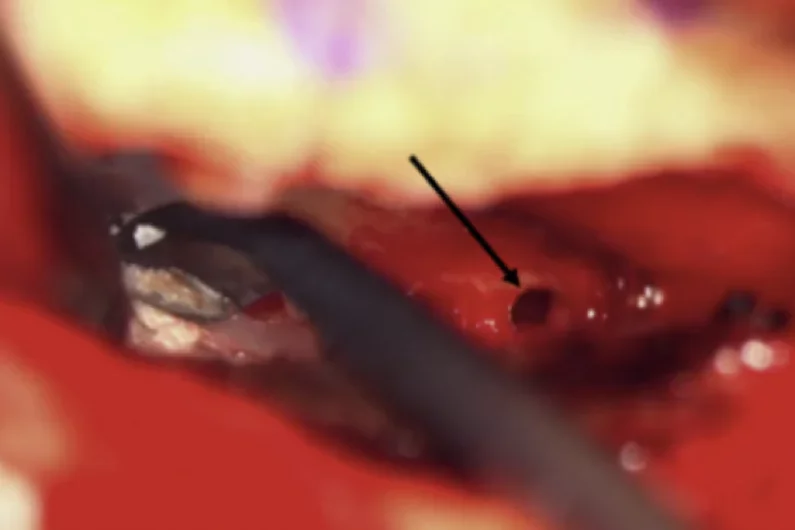 Intraoperative minimally invasive middle fossa craniotomy exposure of the superior semicurcular canal. The arrow indicates the dehiscence.