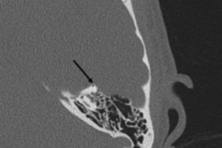 High-resolution computed tomography, which demonstates dehiscence of the left superior semicircular canal