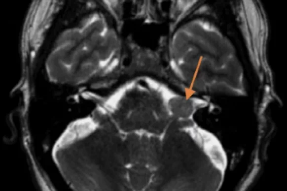 Diffusion sensor imaging tractography in resection for vestibular schwannomma for facial nerve preservation.