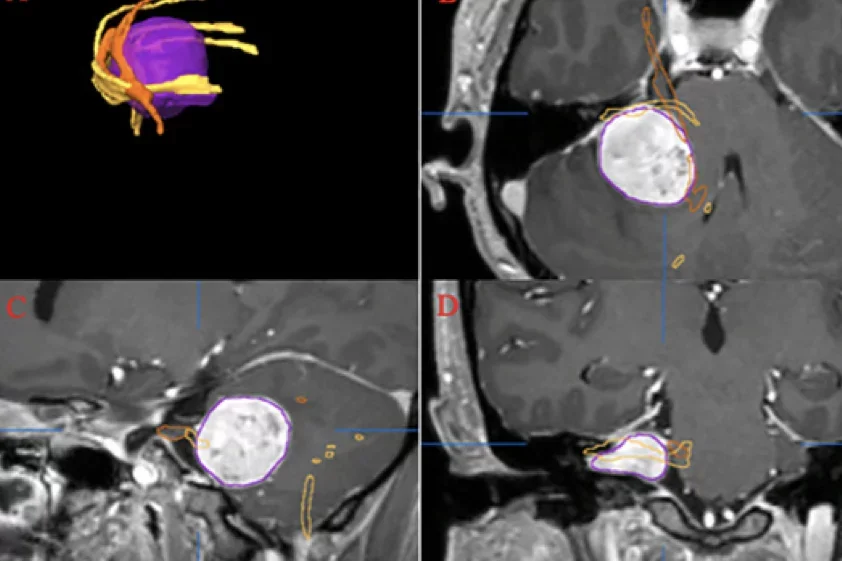 MVI Measured on axial T2-weighted MR images using the ITK-SNAP software.