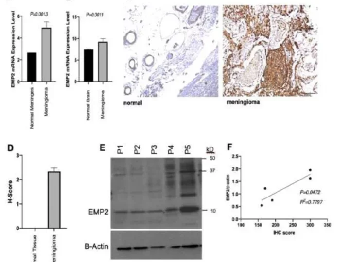 EMP2 mRNA expression is upregulated in meningioma speciments compared to regular meninges (A) and brain tissue samples (B)