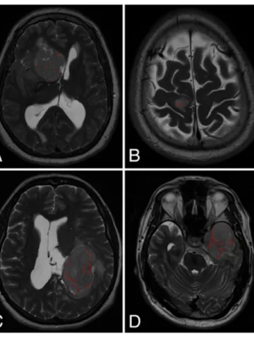MVI Measured on axial T2-weighted MR images using the ITK-SNAP software